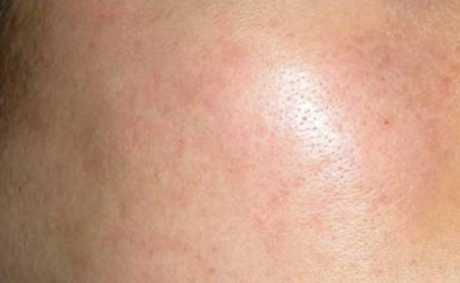 Na TCA-peeling Nimue – dame 5