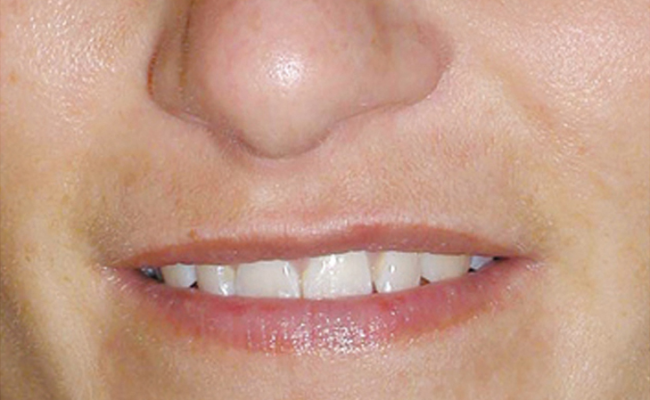 Na TCA-peeling van Nimue – dame 3