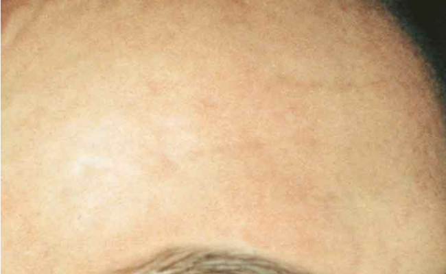 Na TCA-peeling van Nimue – dame 4 (acne)