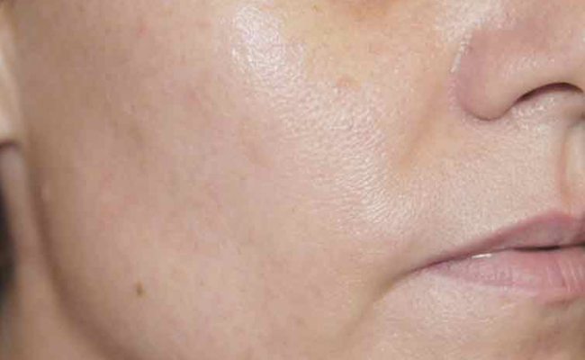 Na een TCA-peeling (fruitzuurbehandeling) van Nimue
