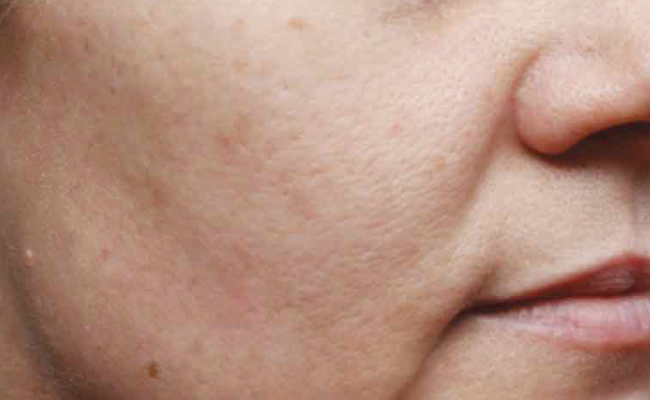 Voor TCA-peeling (fruitzuurbehandeling) van Nimue