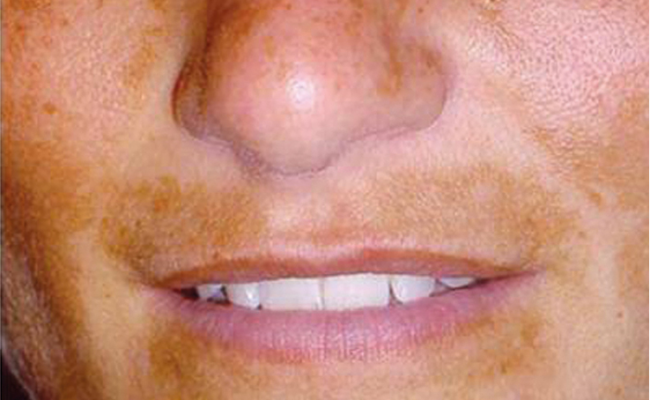 Voor TCA-peeling van Nimue – dame 3