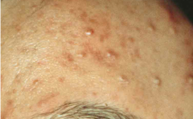 Voor TCA-peeling van Nimue – dame 4