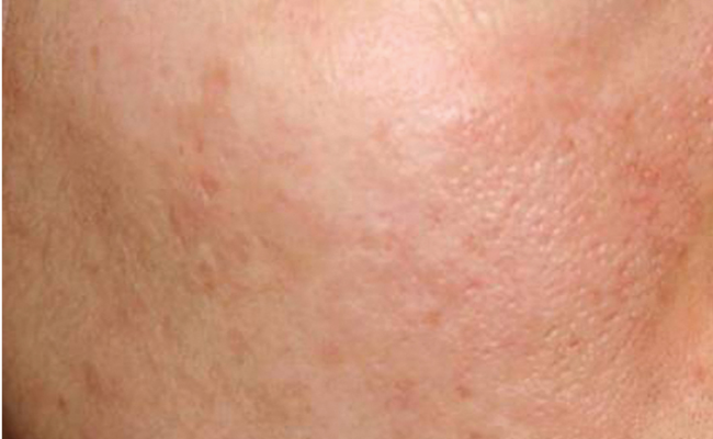 Voor TCA-peeling van Nimue – dame 5